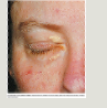 <p>xanthelasma</p>