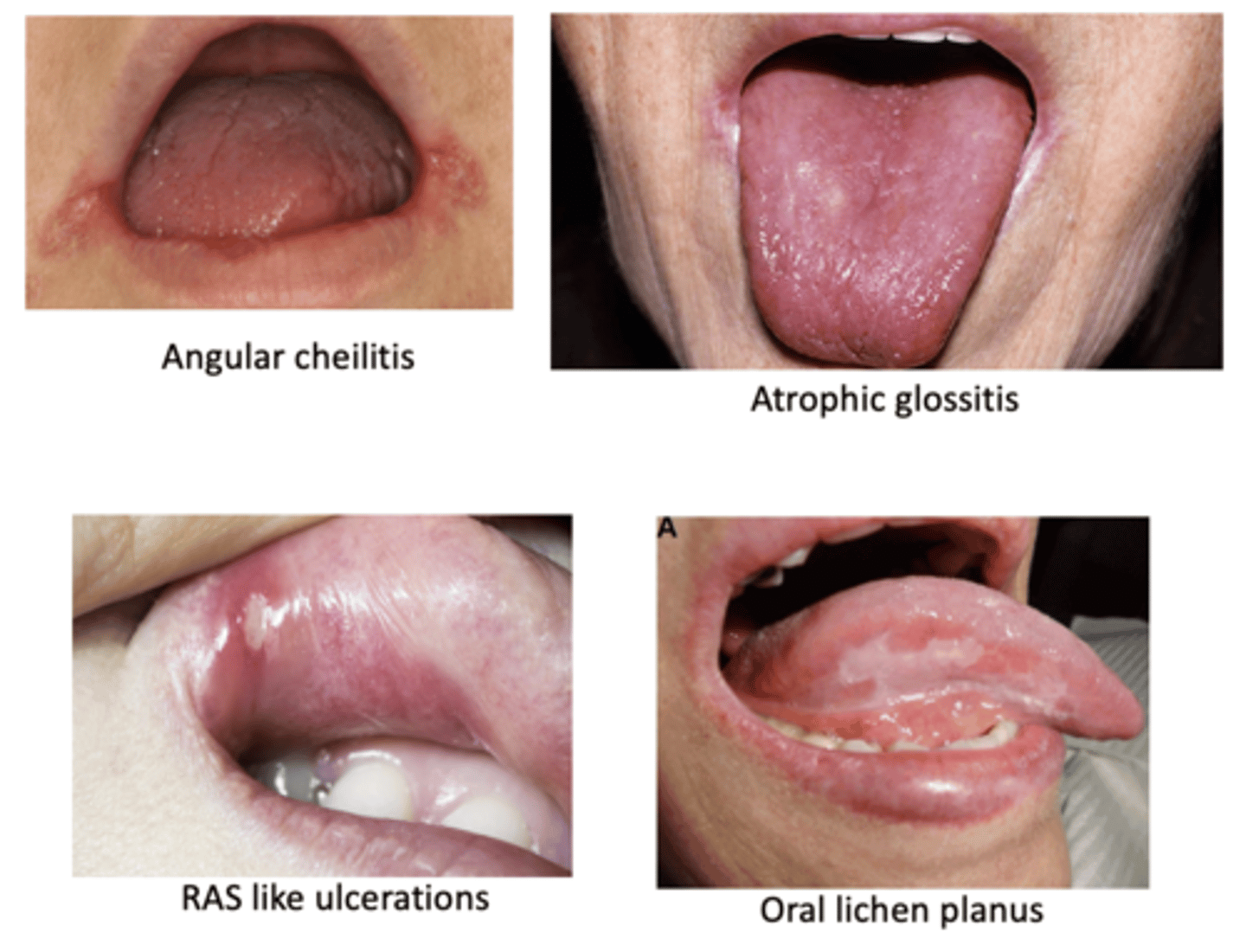 <p>Signs of _____ in the mouth can cause suspicion for these conditions</p><p>• Angular cheilitis</p><p>• Atrophic glossitis</p><p>• RAS like ulcerations</p><p>• Oral lichen planus</p><p>• Xerostomia</p><p>• Numbness</p><p>• Burning sensation</p><p>• Dysgeusia (altered taste perception)</p><p>• Other symptoms/signs: Short of breath, fatigue, pallor</p>