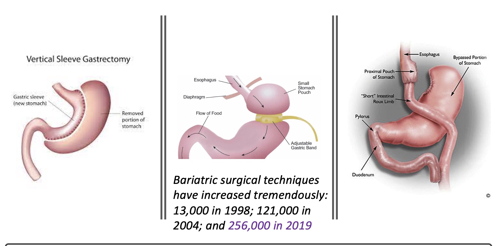 <p><span><span>-May be indicated for individuals with a BMI ≥40 kg ∙ m</span><sup><span>−2</span></sup><span> or those with comorbid risk factors and BMI ≥35 kg ∙ m</span><sup><span>−2</span></sup></span></p><p><span><span>-Exercise will likely facilitate the achievement and maintenance of energy balance post-surgery.</span></span></p><p><span style="font-family: &quot;Courier New&quot;;"><span>o</span></span><span><span>Evidence of improved insulin sensitivity and CRF following surgery</span></span></p><p><span style="font-family: &quot;Courier New&quot;;"><span>o</span></span><span><span>Once cleared for post-surgery exercise, follow the FITT principle for overweight and obese individuals.</span></span></p><p><span style="font-family: &quot;Courier New&quot;;"><span>o</span></span><span><span>Individuals with a history of orthopedic injuries should be assessed to reduce the risk of aggravation by weight-bearing exercise.</span></span></p><p><span><u><span>Options</span></u></span></p><p><span><span>-</span><strong><span>vertical sleeve gastrectomy</span></strong><span>: more common now bc still use stomach</span></span></p><p><span><span>-</span><strong><span>gastric band</span></strong><span>: most common; feel full quicker (so need to change lifestyle otherwise could die)</span></span></p><p><span><span>-</span><strong><span>complete gastric bypass</span></strong><span>: eating any large volume causes distress; but lose stomach nutrition</span></span></p>