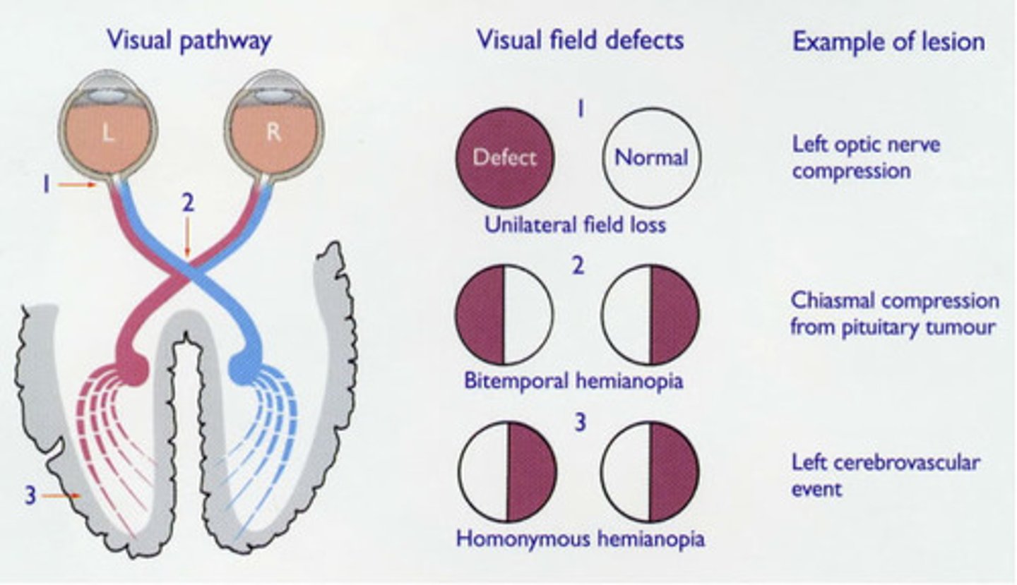 <p>Contralateral (LEFT) homonymous hemianopia</p><p>NOTE: the image depicts damage to the LEFT side</p>