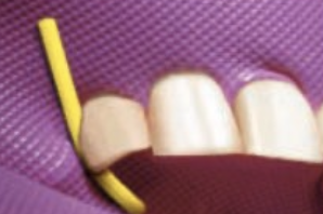 <p>Dental dam stabilizing cord</p>