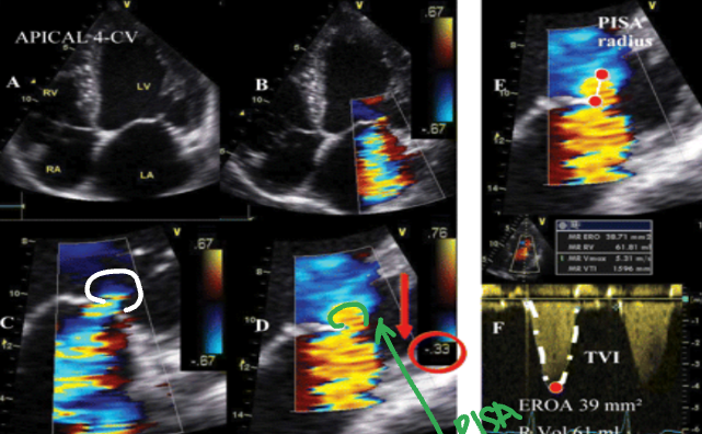 <p>Determine how severe the leaking is. It is measured on top of the vena contracta.</p>