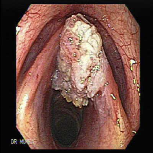 Squamous cell carcinoma of the larynx