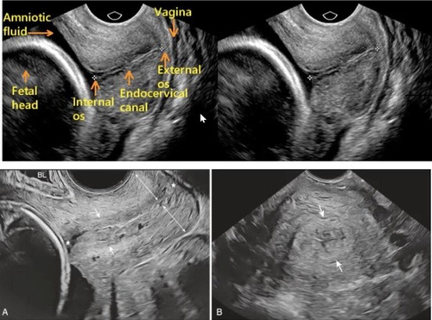 <p>Transvaginal ultrasound</p>