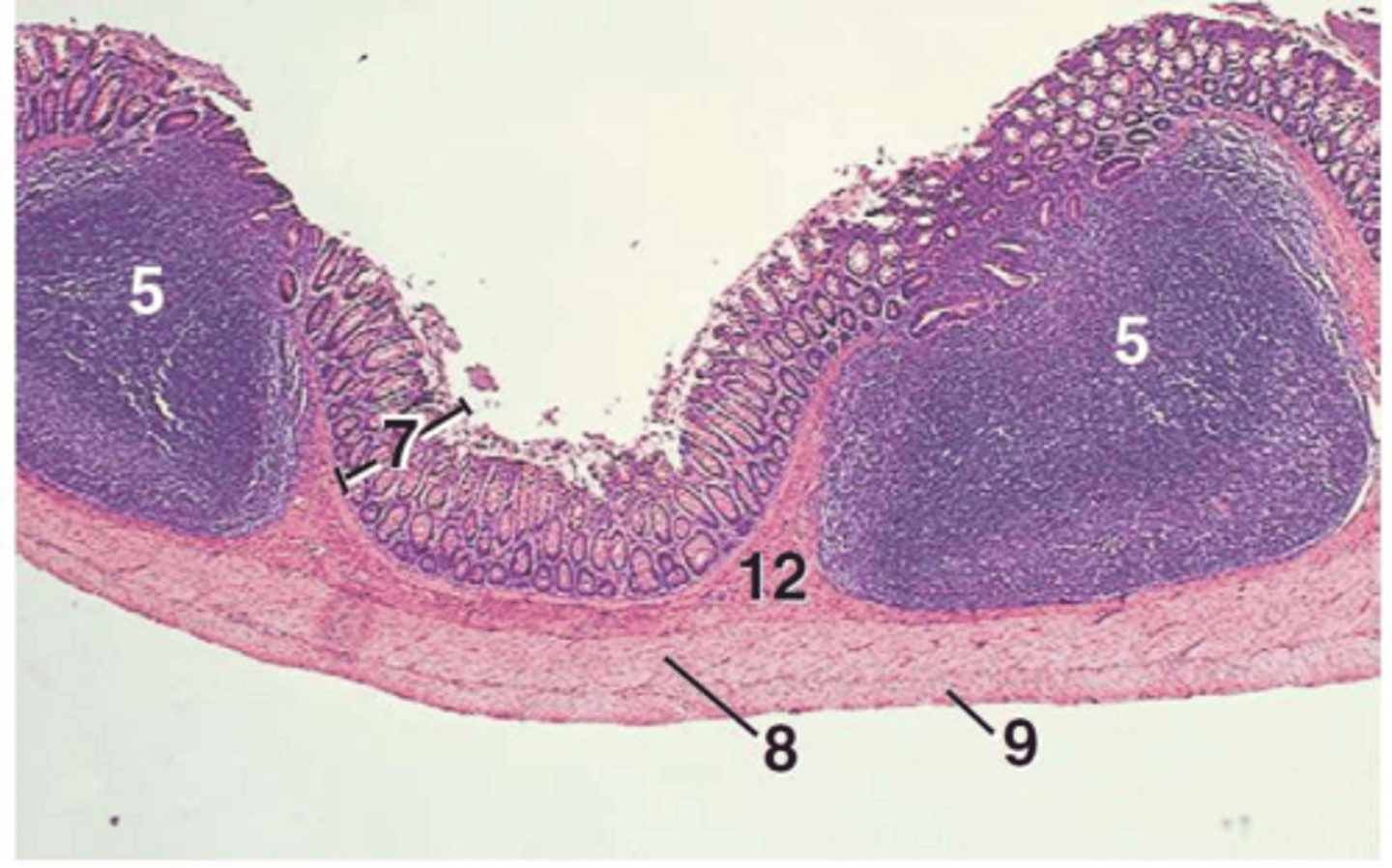 <p>It disrupts the lamina muscularis, allowing intestinal glands to extend into the submucosa.</p>