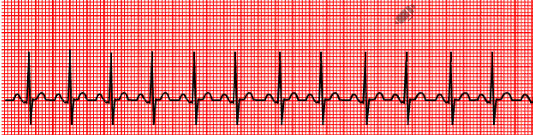 <p>HR is above 100 bpm</p>