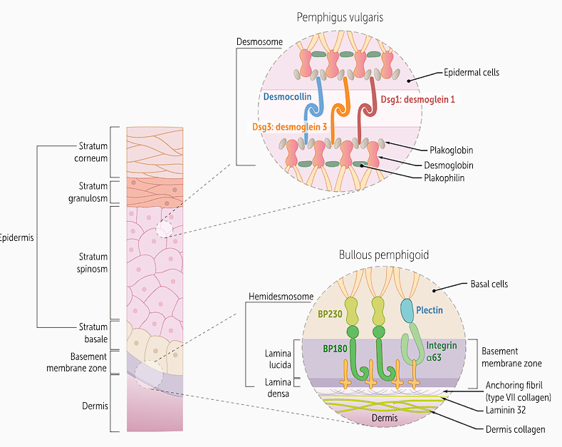 <p>Bullous pemphigoid ; which are the <strong>BP antigen 180 and BP antigen 230 (BP230)</strong></p><ul><li><p>BP180 is the <strong>main transmembrane protein </strong>that adheres basal keratinocytes in the <strong>stratum basalis layer </strong>of the epidermis to the basement membrane; </p></li><li><p>BP230 is an <strong>intracellular protein </strong>that links the <strong>intermediate filaments to hemidesmosomes</strong>.</p></li></ul><p></p>
