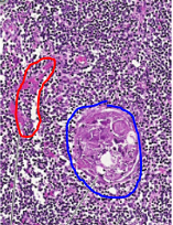 <p><span style="color: red;"><strong>ROJO</strong></span><strong>:</strong> VASOS SANGUÍNEOS</p><p><span style="color: blue;"><strong>AZUL:</strong></span> CORPÚSCULO DE HASSALL</p><p>CÉLULAS PEQUEÑAS TEÑIDAS DE AZUL SON LINFOCTIOS T EN DESARROLLO (TIMOCITOS)</p>