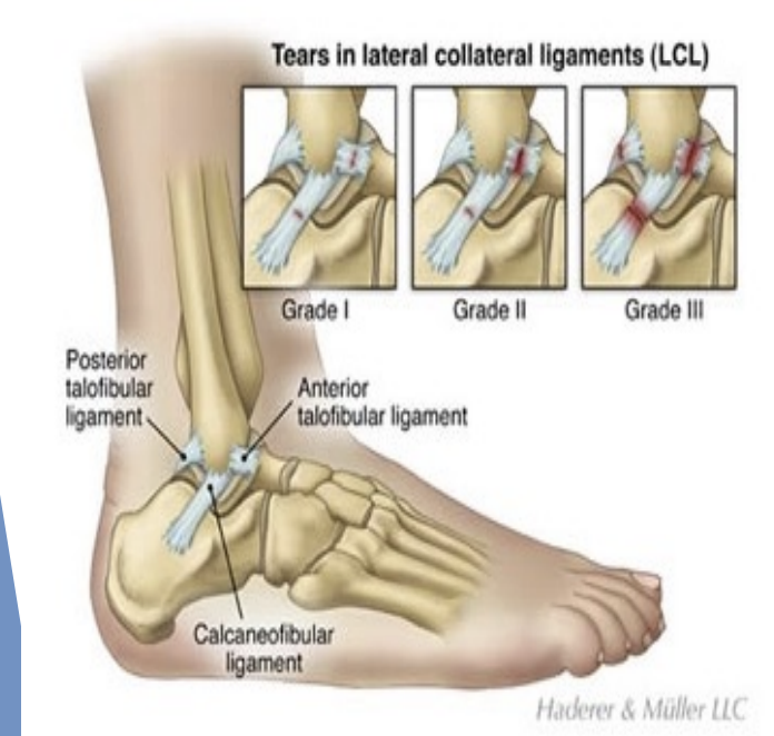 <p>Lateral (Inversion) Ankle Sprain</p>