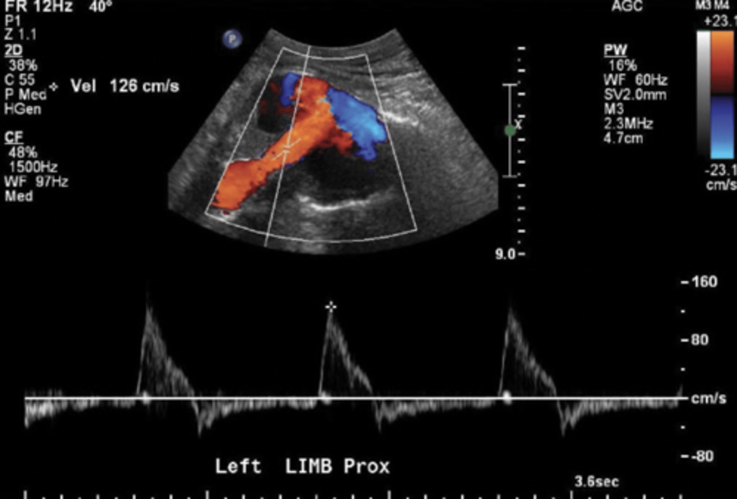 <p>Modular disconnection of graft segments or fabric disruption (fracture)</p><p>Waveform similar to regular graft waveform</p><p>High flow</p>
