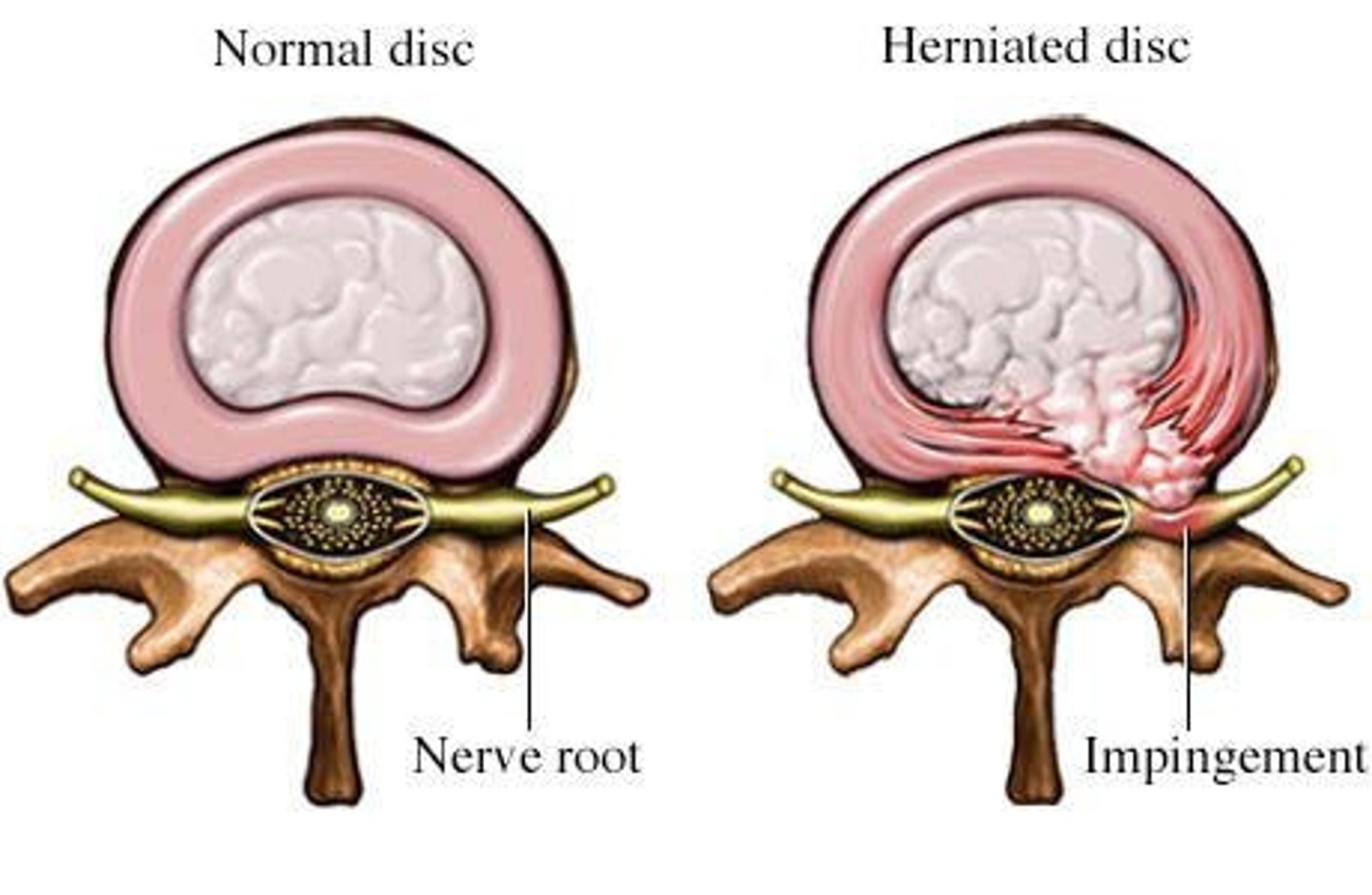 <p>A condition where the breakdown of the annulus fibrosus causes pain and increased risk of disc herniation, potentially leading to the escape of the nucleus pulposus.</p>