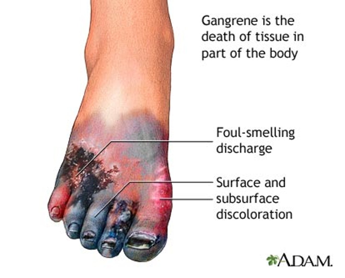 <p>A common condition where a limb dies and the rot spreads to other limbs</p>