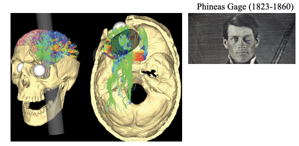 <ul><li><p>phineas gage case</p></li><li><p>damage to areas of the frontal lobe resulting from accident working on railroad</p></li><li><p>significant (but transient) changes in aggression and behavioral inhibition</p></li><li><p>personality changed significantly overtime, started to exhibit increasing aggression, social behavior changed, developed deficits in decision making</p></li><li><p>but still could function in society to some extent</p></li></ul><p></p>