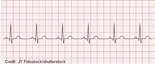 <ul><li><p>rate = 60-100 BPM or equivalent age-appropriate rate in children</p></li><li><p>QRS complex preceded by P wave</p></li><li><p>P waves upright in I and II, inverted in AVR</p></li><li><p>PR interval constant</p></li><li><p>QRS complexes &lt;100 mm wide</p></li></ul><p></p>