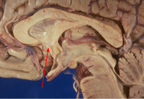 -end of neural tube
-end of 3rd ventricle
Membrane superior to the Optic Chiasm, forming the anterior wall of the 3rd Ventricle