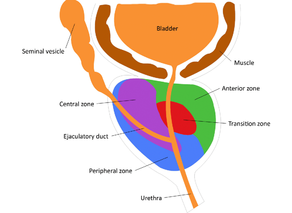 <p>A. periurethral zone of the prostate</p><p>This zone surrounds the <strong>prostatic urethra</strong>, and hyperplasia here directly compresses the urethra</p>