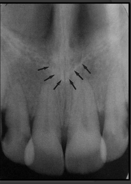 <p>It is the sharp triangular point of the nose that has the tip pointing to the central incisors. It is radio opaque and triangular in shape.</p>