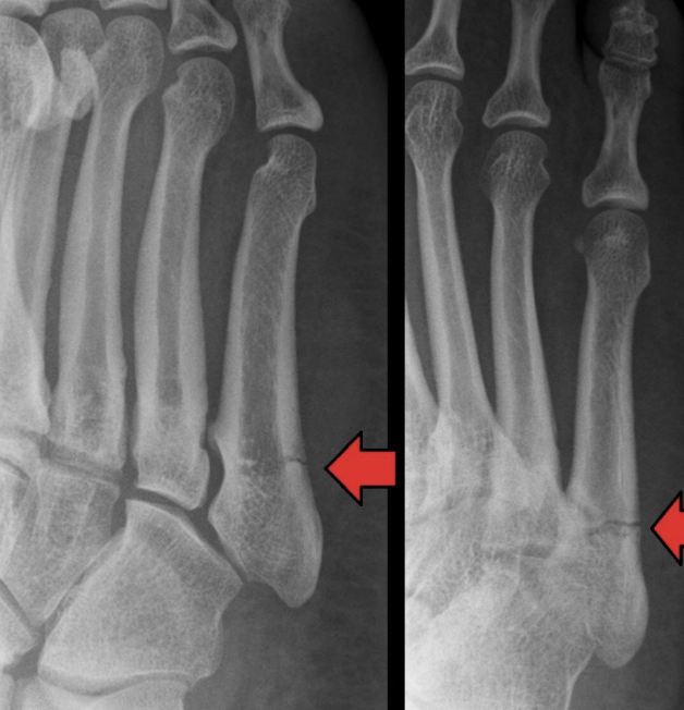 <p>Name this fracture</p>