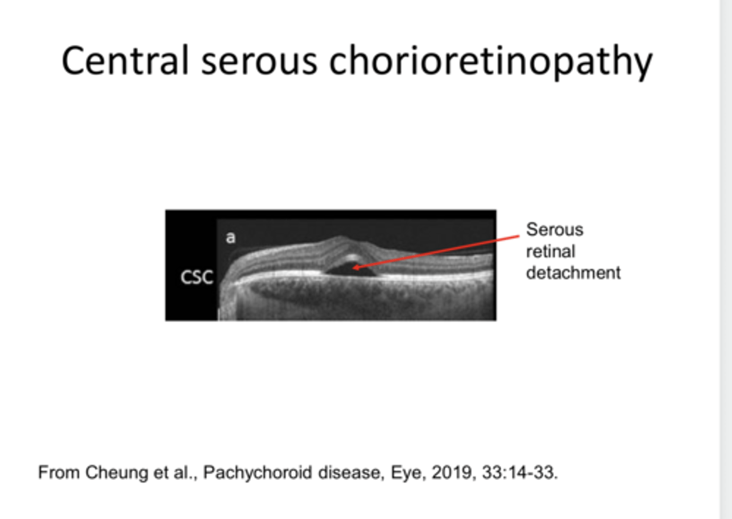 <p>Central Serous Retinopathy -- Macular OCT (Pic)</p><p>**closer to typical</p>