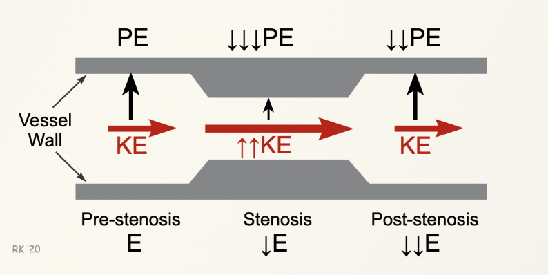 <p>KE: Represents the energy of blood flow; it <strong>increases as blood passes through a stenosis </strong> As the diameter of the vessel decreases, blood velocity increases to maintain flow, which raises kinetic energy.</p><p>Potential Energy (PE): Relates to the pressure within the vessel; approaching the stenosis PE is at its highest as blood flows through a stenosis, pressure drops and makes PE at it lowest. Post stenosis PE increase and KE decreases but it’s still not as high as it was pre-stenosis </p><p></p>