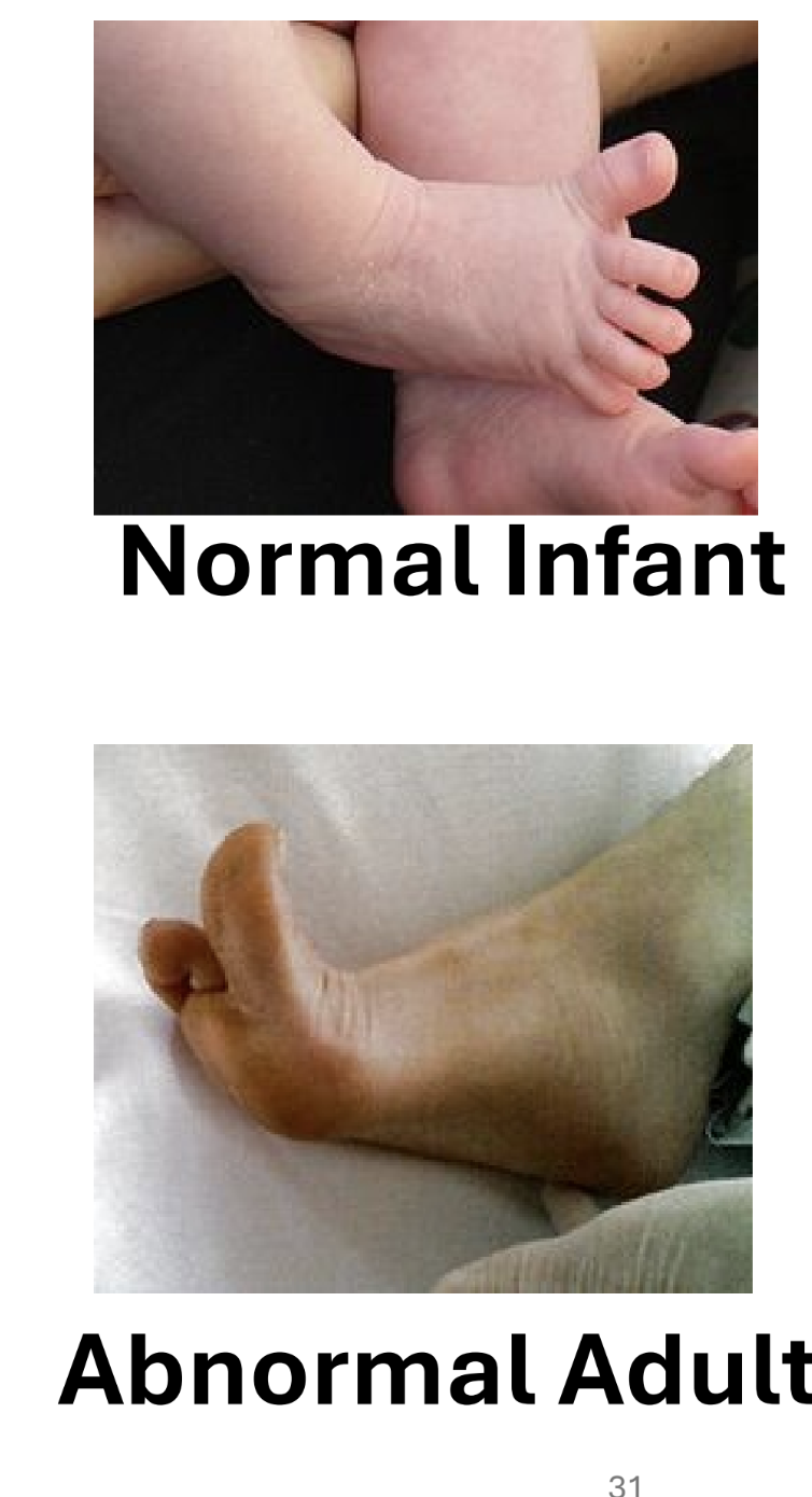 <ul><li><p>upper motor neuron normally keeps sensory impulse from spreading to other nerve roots</p></li><li><p><strong>normal stimulation</strong> of sole: baby - hallux extension</p><ul><li><p>adults - all toes curl and adduct</p></li></ul></li><li><p>damage = impulse distribution not controlled, adult responds like infant</p></li></ul><p></p>