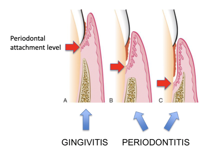 <p>• Periodontal pocket formation</p><p>• Gingival recession</p><p>• Root exposure</p><p>• Bone loss</p><p>• Tooth loosening</p><p>• Tooth loss</p>