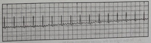 <p>Using the EKG tracing, identify the arrhythmia.</p><p>A. Atrial flutter</p><p>B. Ventricular fibrillation</p><p>C. Atrial fibrillation</p><p>D. Supraventricular tachycardia</p>
