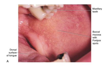 <ul><li><p>variable number of these are scattered throughout the tissue</p></li><li><p>are a variant usually present in the oral cavity, which are visible as small, yellowish bumps on the surface of oral mucosa</p></li><li><p>correspond to deposits of sebum from misplaced sebaceous glands in submucosa</p></li></ul><p></p>