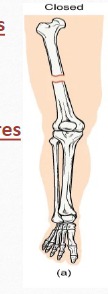 <p>A fracture in which the skin remains intact </p>