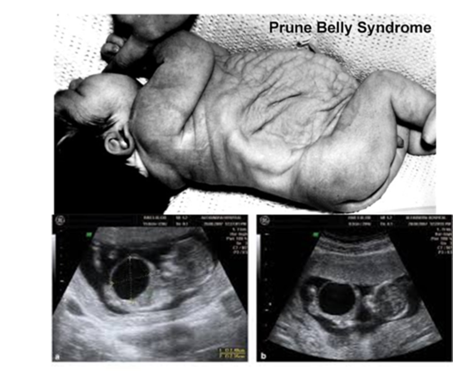 <p>Characterized by lack of abdominal muscles, megacystis/megaureter, and bilateral cryptorchidism; can be lethal or mild.</p>