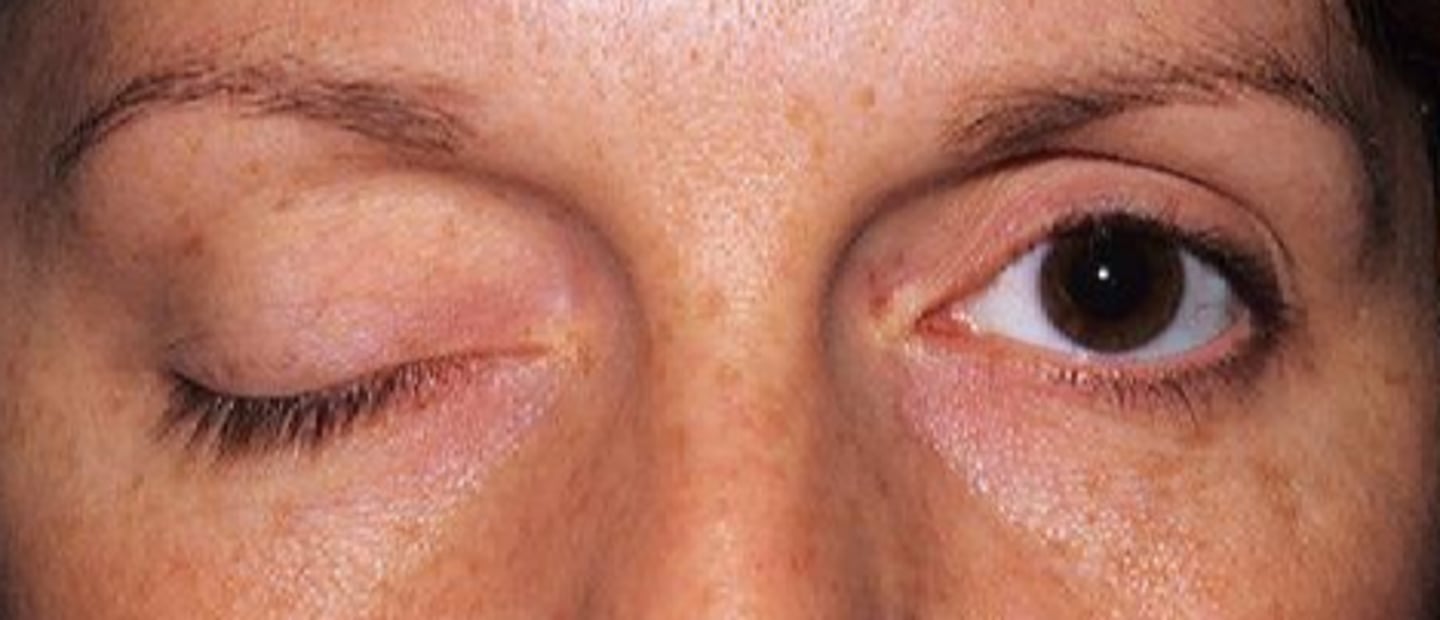 <p>CN 3 palsy = lids completely shut</p><p>Horner's syndrome = subtle ptosis</p><p>MG = lid droop that fatigues with sustained upgaze, later in day</p><p>hemifacial spasm </p><p>hyperkinetic lid syndrome</p>