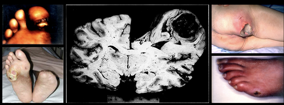 <p>Necrosis with abscess formation of tissue by lysosomal enzymes due to infection. Found in brain tissue, skin, wound, joint infections</p><p>Ex: late pressure sores </p>