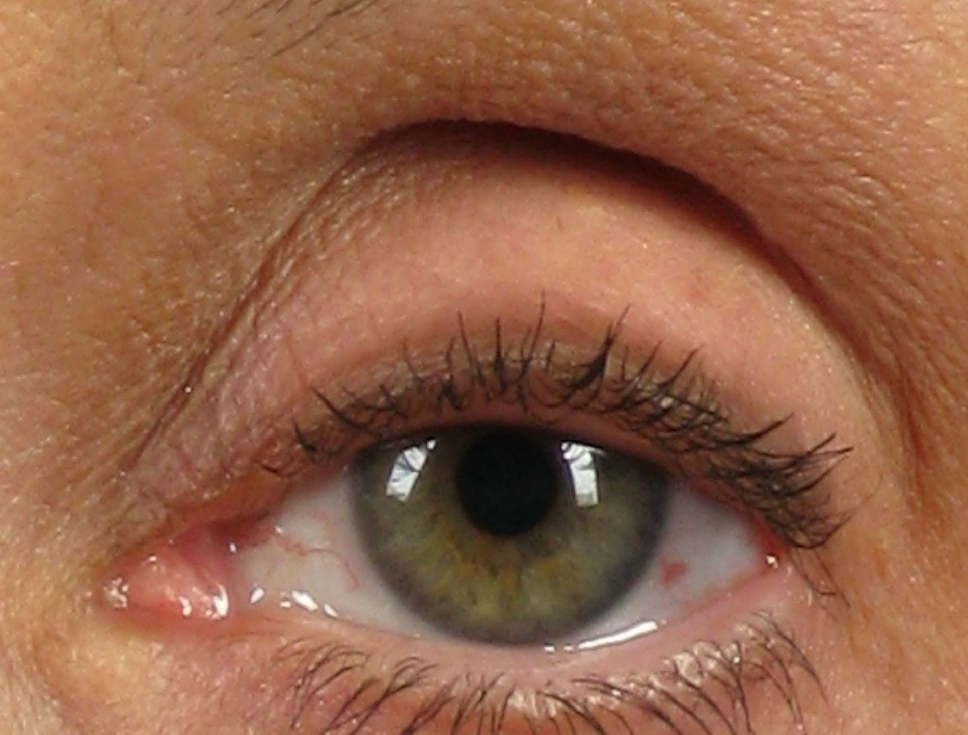 <p>Superior palpebral sulci</p>