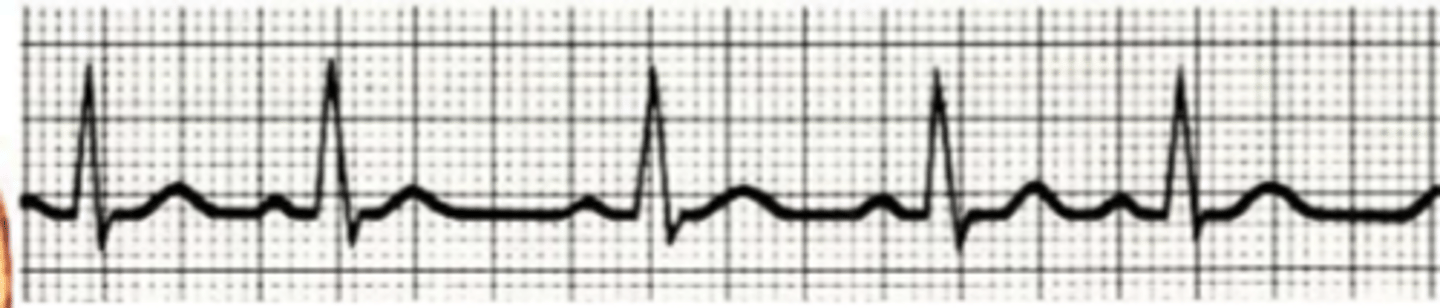<p>Describe the arrhythmia.</p>