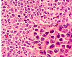 <p><span style="background-color: transparent; font-family: "Times New Roman", serif;">*sheets of plasma cells in various degrees of differentiation</span></p><p><span style="background-color: transparent; font-family: "Times New Roman", serif;">*plasma cells have eccentric nucleus, perinuclear halo, clockface nucleus</span></p>