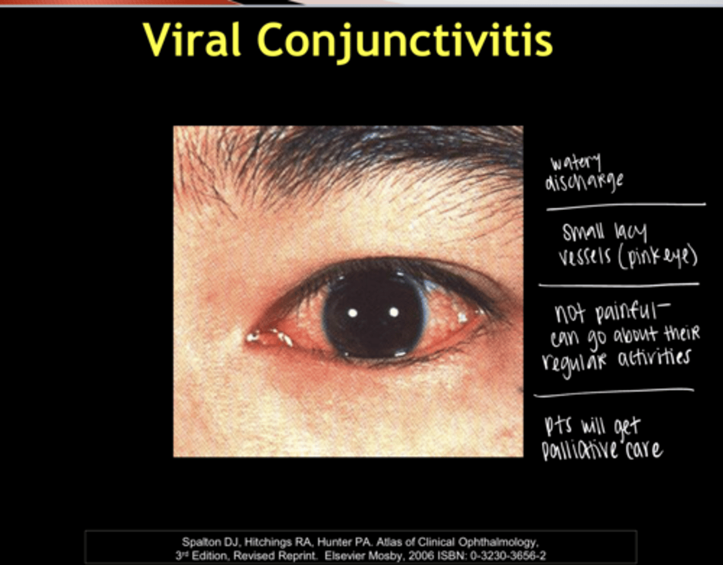<p>What are the common symptoms of viral conjunctivitis?</p>