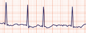 <p>Which cardiac rhythm is shown?</p>