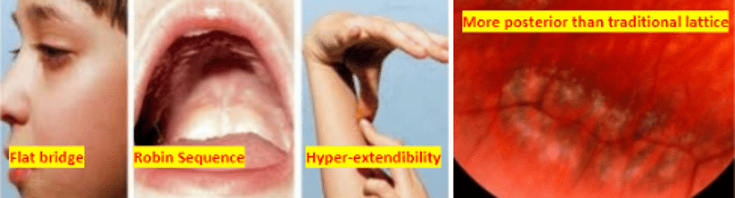 <p>an autosomal dominant syndrome which is a disorder of collagen resulting in abnormal vitreous, myopia, orofacial abnormalities, and deafness. The most common inherited cause of retinal detachment in children. Involves optically empty vitreous, lattice like degeneration posteriorly, high myopia, and lamellar cataract.</p>