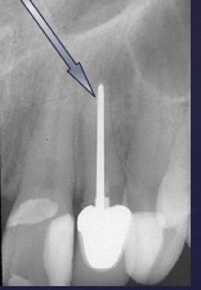 <p>Identify restoration type</p>