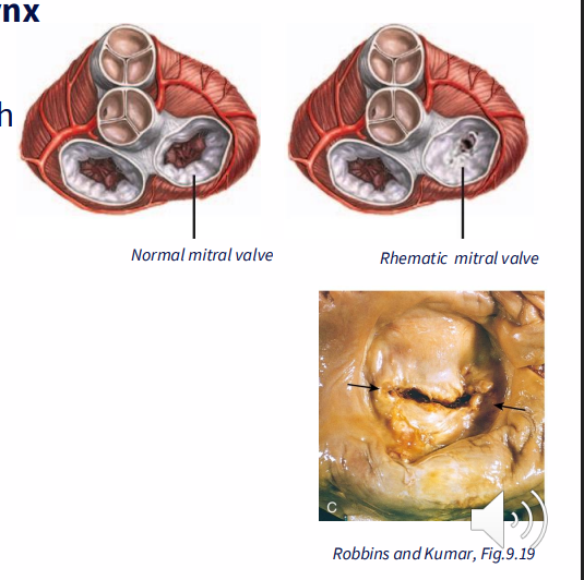 <p>CAUSE: Streptococcal infection of tonsils and pharynx</p><p>Rheumatic Fever:</p><p>- anti-streptococcal antibodies are cross-reactive with cardiac tissue</p><p>- Fibrosis, stenosis (narrowing) of mitral valve</p><p>- pressure buildup in left atrium</p><p>- Dilation of left atrium; hypertrophy</p><p>- atrial fibrillation; congestive heart failure</p><p>.</p><p>- Common in poor socioeconomic conditions</p><p>- 15.6 million people</p><p>- Poor access to healthcare, nutrition</p>