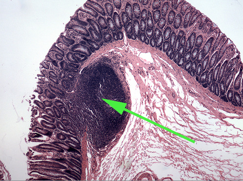 <p><span>The green arrow is indicating the peyer's patch in this area of the small intestine. It is made up of a dense accumulation of what kind of cells?//<strong>lymphocytes</strong></span></p>
