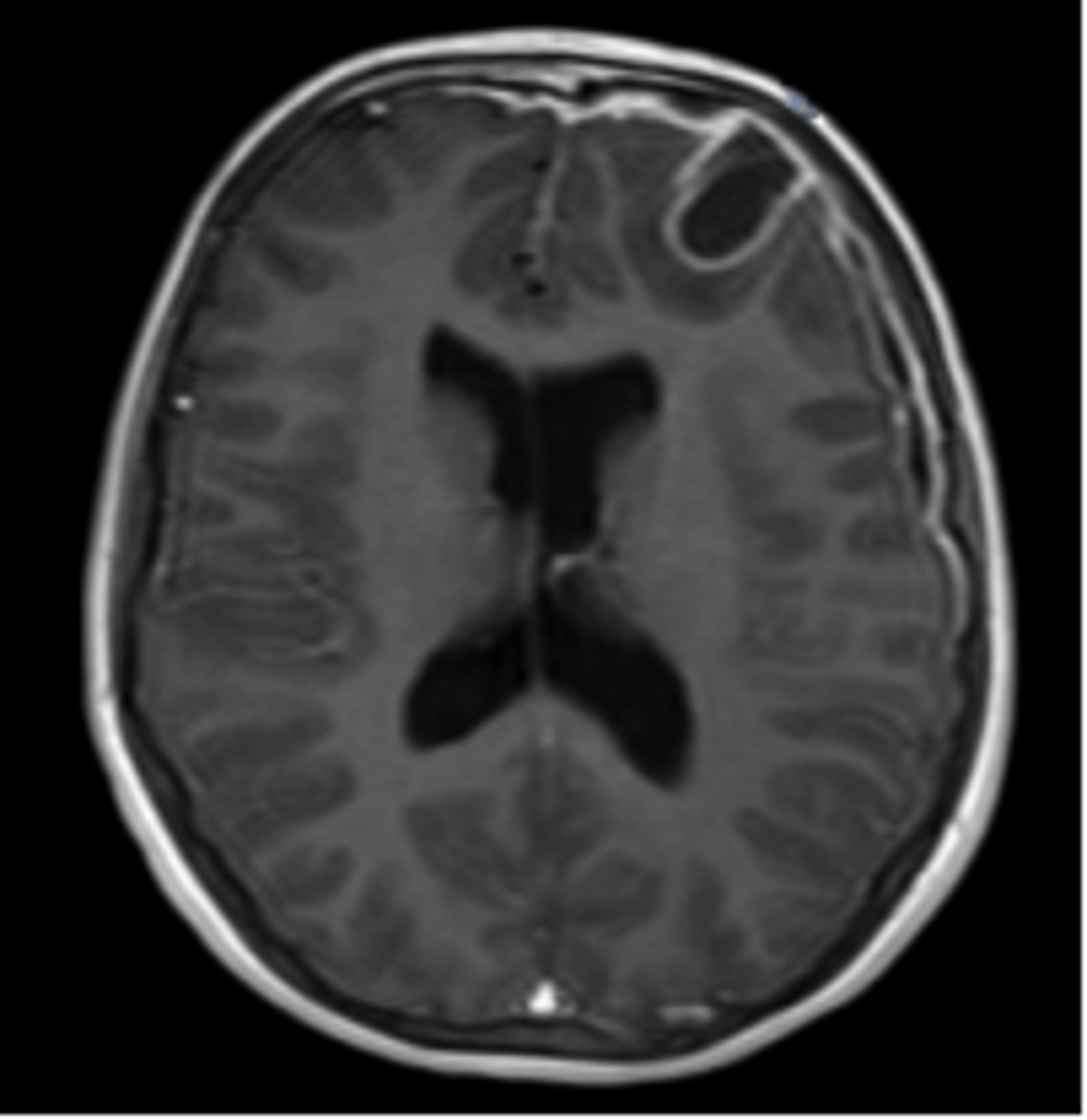 <p>collection of pus between dura mater and arachnoid mater</p>