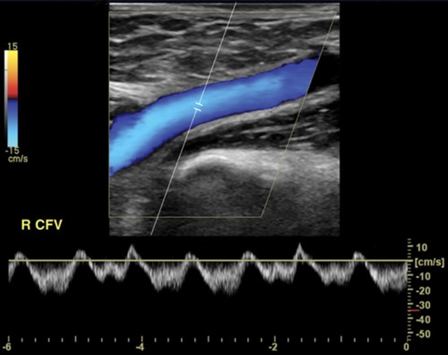 <p>Spontaneous</p><p>Respirophasic</p><p>Unidirectional</p><p>Augments with distal compression</p><p>Ceases with Valsalva maneuver</p>