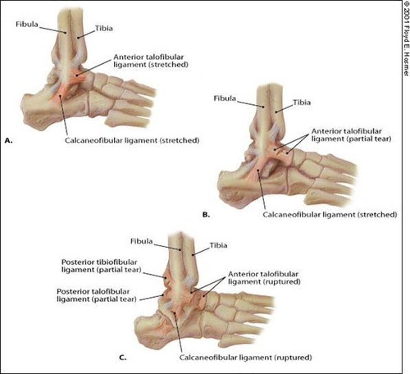 <p>Grade 1 → partial tear of the ATFL</p><p>Grade 2 → partial to complete tear of the ATLF + CFL</p><p>Grade 3 → complete rupture of the ATLF + CFL</p>