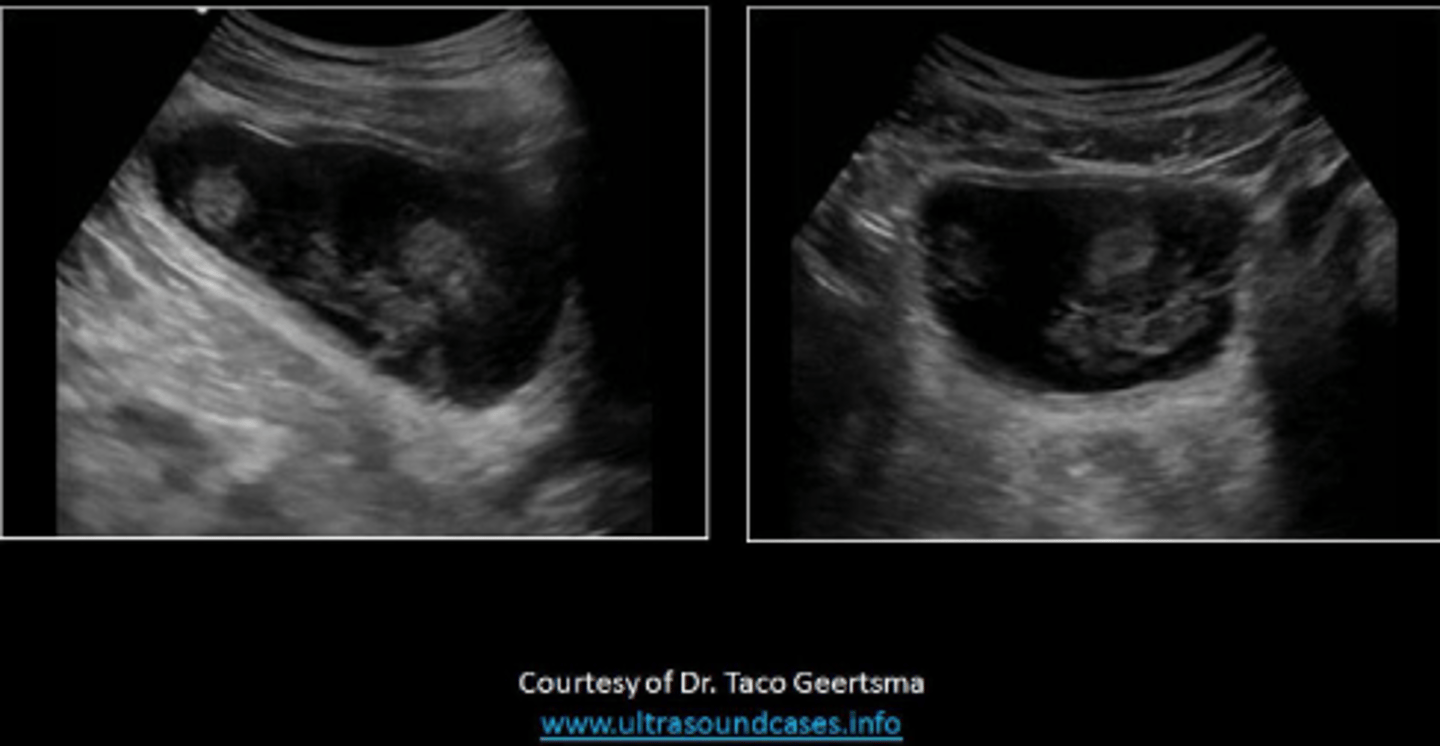 <p>It is necessary to change the patient position while scanning to determine mass mobility.</p>