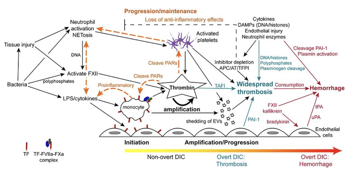 <ol><li><p>Sepsis trigger (infection → PAMPs → immune activation)</p></li><li><p>Cytokine storm (TNF-α, IL-1, IL-6)</p></li><li><p>Endothelial activation &amp; tissue factor expression</p></li><li><p>Activation of coagulation cascade (extrinsic pathway → thrombin → fibrin)</p></li><li><p>Inhibition of anticoagulants (<span>↓ antithrombin, ↓ protein C, ↓ TFPI)</span></p></li><li><p><span>Suppression of fibrinolysis (↑ PAI-1 = </span>↓ tPA activity)</p></li><li><p>Widespread microvascular thrombosis (multi-organ ischemia)</p></li><li><p>Consumption of clotting factors &amp; platelets </p></li><li><p>Bleeding phase (petechiae, mucosal bleeding, hemorrhage)</p></li></ol><p></p>