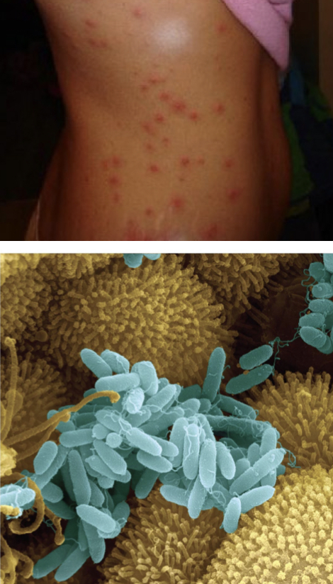 *Pseudomonas* Infections