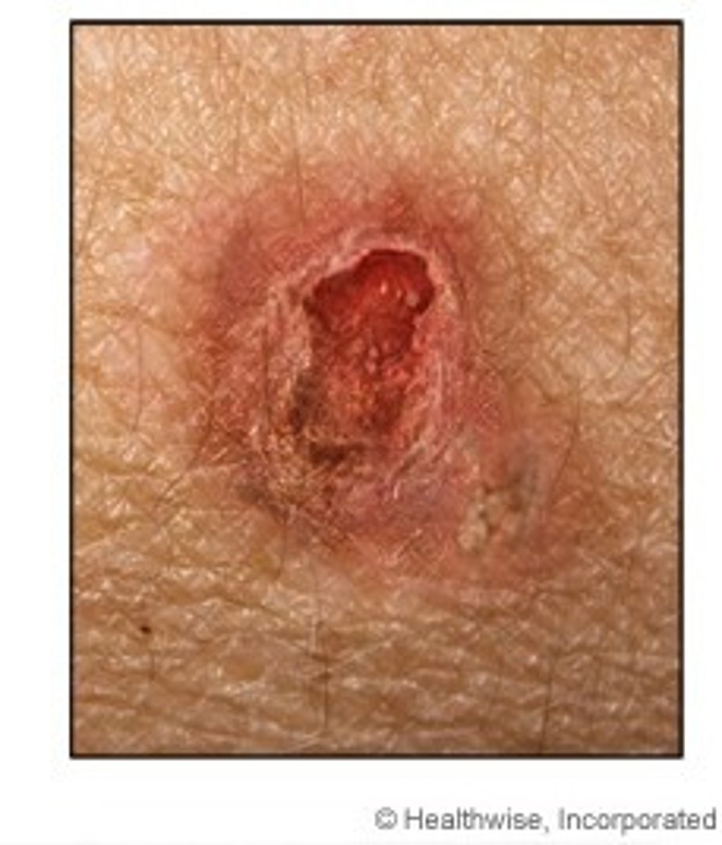 <p>2nd most common cancer. Primary cause UV ray exposure</p>