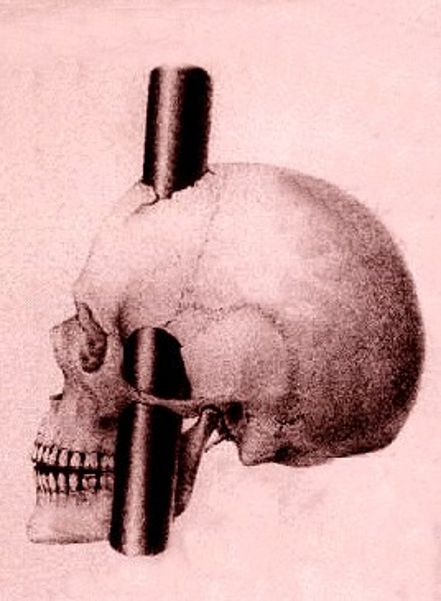 <p>1848 railroad worker that was injured by a tamping iron traveling through his brain and separating his frontal lobe from his limbic system; early case of changes in the brain</p>