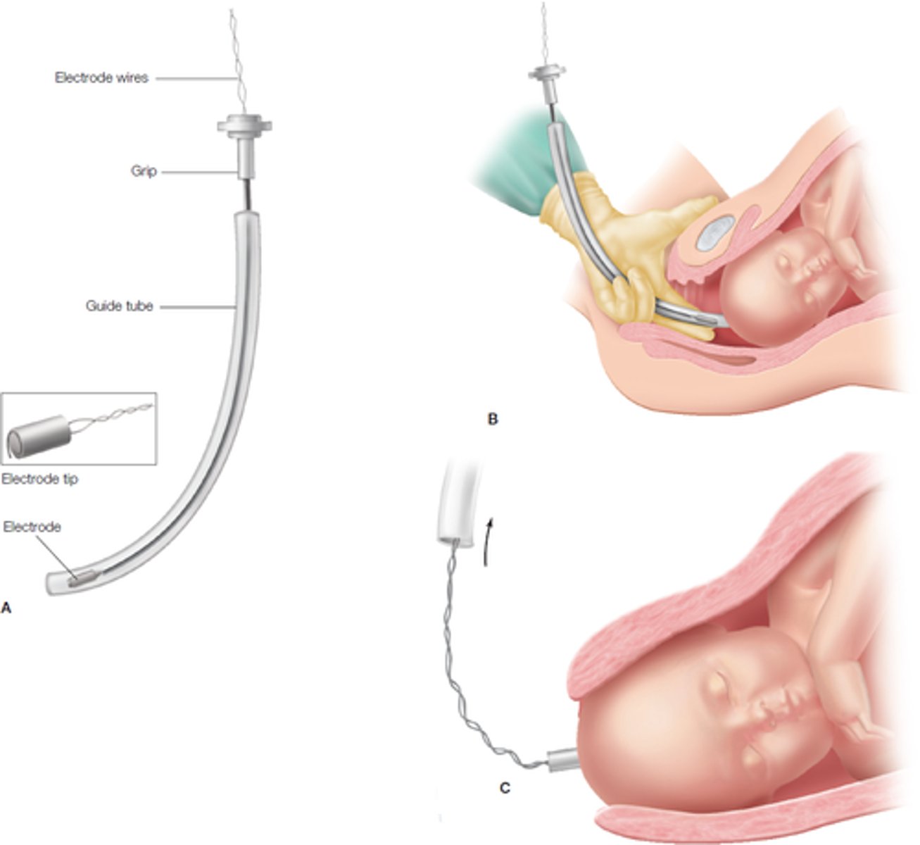 <p>Small electrode attached to the fetal scalp that senses the potential differences created by the depolarization of the fetal heart</p>